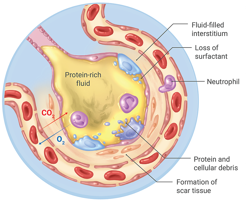 severe case of covid-19